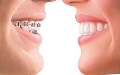 Dentista explica quais os tipos mais comuns de tratamento para alinhamento dos dentes