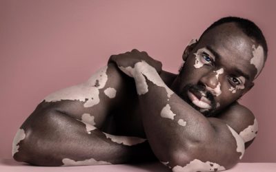 Contra fake news sobre vitiligo, dermatologistas lançam podcast com esclarecimentos sobre a doença