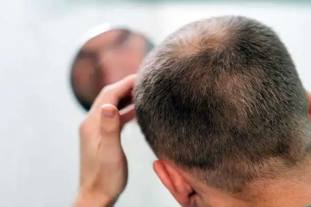 Aché promove campanha com o tema Alopecia